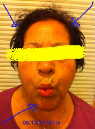 After 9th Acupuncture session.