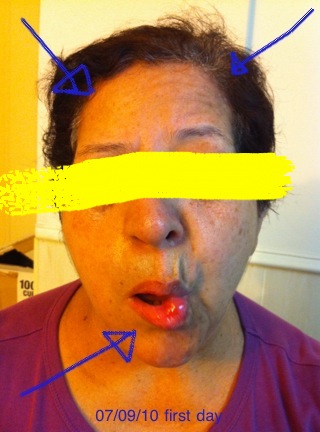 Before Acupuncture session.